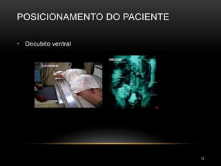 POSICIONAMENTO DO PACIENTE
13
• Decubito ventral
 