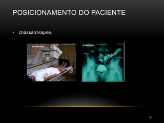 POSICIONAMENTO DO PACIENTE
16
• chassard-lapne.
 