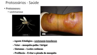 Protozoários - Saúde
• Protozooses:
• Leishmaniose
- Vetor – mosquito-palha / birigui
- Agente Etiológico - Leishmania brasiliensis
- Sintomas – Lesões cutâneas
- Profilaxia – Evitar a picada do mosquito
 