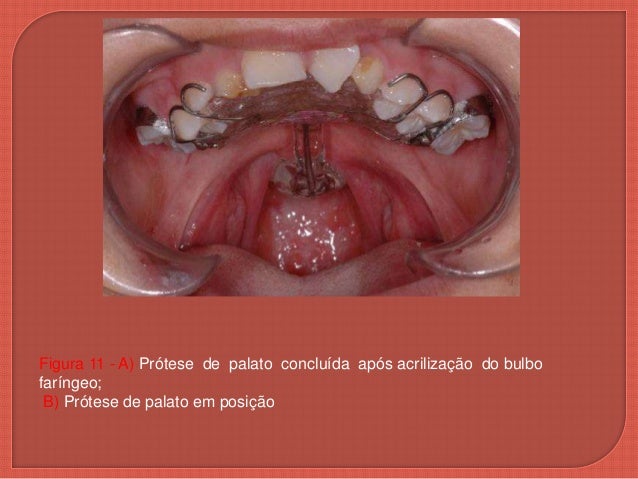 Pr tese Para Paciente Com Fissura De Palato pr-tese-para-paciente-com-fissura-de-palato