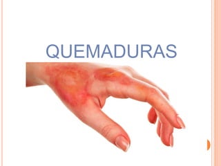 QUEMADURAS
 