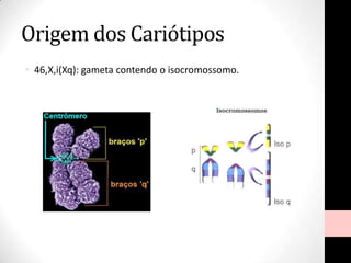 Origem dos Cariótipos
• 46,X,i(Xq): gameta contendo o isocromossomo.
 