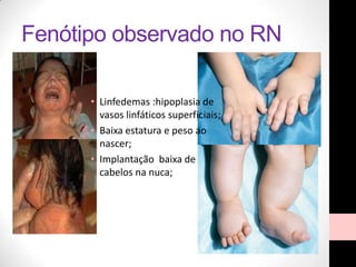 Fenótipo observado no RN
• Linfedemas :hipoplasia de
vasos linfáticos superficiais;
• Baixa estatura e peso ao
nascer;
• Implantação baixa de
cabelos na nuca;
 