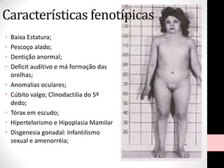 Características fenotípicas
• Baixa Estatura;
• Pescoço alado;
• Dentição anormal;
• Deficit auditivo e má formação das
orelhas;
• Anomalias oculares;
• Cúbito valgo; Clinodactilia do 5º
dedo;
• Tórax em escudo;
• Hipertelorismo e Hipoplasia Mamilar
• Disgenesia gonadal: Infantilismo
sexual e amenorréia;
 