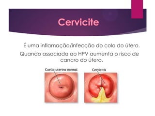 É uma inflamação/infecção do colo do útero.
Quando associada ao HPV aumenta o risco de
cancro do útero.

 