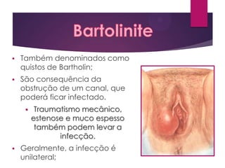 

Também denominados como
quistos de Bartholin;



São consequência da
obstrução de um canal, que
poderá ficar infectado.




Traumatismo mecânico,
estenose e muco espesso
também podem levar a
infecção.

Geralmente, a infecção é
unilateral;

 
