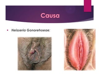 Neisseria Gonorehoeae;

 