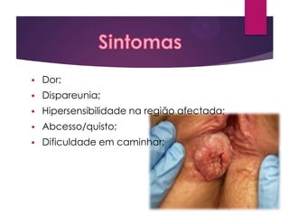 

Dor;



Dispareunia;



Hipersensibilidade na região afectada;



Abcesso/quisto;



Dificuldade em caminhar;

 