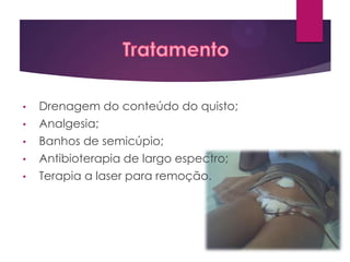 •
•
•
•
•

Drenagem do conteúdo do quisto;
Analgesia;
Banhos de semicúpio;
Antibioterapia de largo espectro;
Terapia a laser para remoção.

 