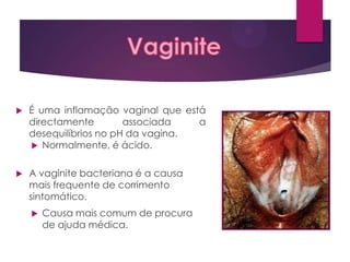

É uma inflamação vaginal que está
directamente
associada
a
desequilíbrios no pH da vagina.
 Normalmente, é ácido.



A vaginite bacteriana é a causa
mais frequente de corrimento
sintomático.


Causa mais comum de procura
de ajuda médica.

 
