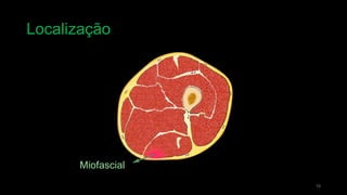 Localização
10
Miofascial
 