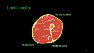 Localização
12
Miofascial Miotendíneo
Intratendíneo
 