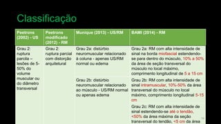 Grau 1:
sangramento
focal/difuso,
lesões < 5%
do volume
muscular ou
da área de
secção
transversal
Grau 1:
edema sem
distorção
arquitetural
Grau 1a: distúrbio muscular
induzido por fadiga - RM/US
normal
Grau 1a: RM com alta intensidade de
sinal na borda miofascial: <10% de
extensão no ventre muscular,
comprimento longitudinal <5 cm
Grau 1b: DOMS - US/RM
normal ou apenas edema
Grau 1b: RM com alta intensidade de
sinal intramuscular <10% da área
transversal do músculo, comprimento
longitudinal < 5 cm
Grau 2:
ruptura
parcila –
lesões de 5-
50% do
volume
muscular ou
do diâmetro
transversal
Grau 2:
ruptura parcial
com distorção
arquitetural
Grau 2a: distúrbio
neuromuscular relacionado
à coluna - apenas US/RM
normal ou edema
Grau 2a: RM com alta intensidade de
sinal na borda miofascial estendendo-
se para dentro do músculo, 10% a 50%
da área de seção transversal do
músculo no local máximo,
comprimento longitudinal de 5 a 15 cm
Grau 2b: distúrbio
neuromuscular relacionado
ao músculo - US/RM normal
ou apenas edema
Grau 2b: RM com alta intensidade de
sinal intramuscular, 10%-50% da área
transversal do músculo no local
máximo, comprimento longitudinal 5-15
cm
Grau 2c: RM com alta intensidade de
sinal estendendo-se até o tendão,
<50% da área máxima da seção
transversal do tendão, <5 cm da área
Classificação
16
Peetrons
(2002) - US
Peetrons
modificado
(2012) - RM
Munique (2013) - US/RM BAMI (2014) - RM
 