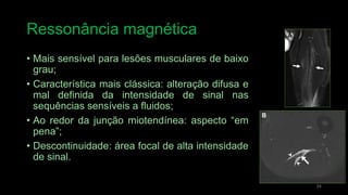 Ressonância magnética
• Mais sensível para lesões musculares de baixo
grau;
• Característica mais clássica: alteração difusa e
mal definida da intensidade de sinal nas
sequências sensíveis a fluidos;
• Ao redor da junção miotendínea: aspecto “em
pena”;
• Descontinuidade: área focal de alta intensidade
de sinal.
24
 