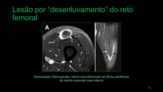 Lesão por “desenluvamento” do reto
femoral
25
Dissociação intermuscular: rotura circunferencial nas fibras periféricas
do ventre muscular mais interno
 