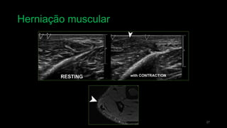 Herniação muscular
27
 