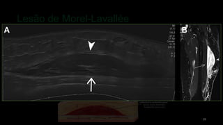 Lesão de Morel-Lavallée
28
 