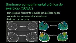 Síndrome compartimental crônica do
exercício (SCEC)
• Dor crônica e recorrente induzida por atividade física;
• Aumento das pressões intramusculares;
• Melhora com repouso.
31
 