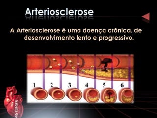 A Arteriosclerose é uma doença crônica, de
     desenvolvimento lento e progressivo.
 Izabella Gon
 