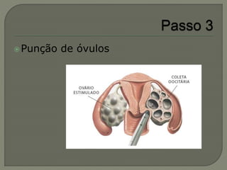 Punção de óvulos
 