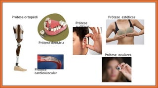 Prótese ortopédica
Prótese dentária
Prótese
cardiovascular
Prótese
auditivas
Prótese oculares
Prótese estéticas
 