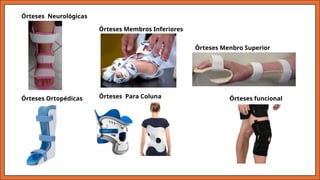Órteses Ortopédicas
Órteses Membros Inferiores
Órteses Menbro Superior
Órteses Para Coluna Órteses funcional
Órteses Neurológicas
 