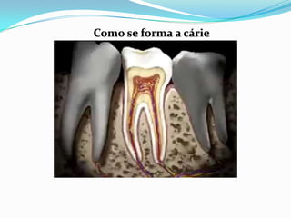 Como se forma a cárie
 
