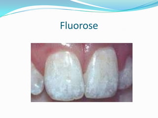 Fluorose
 
