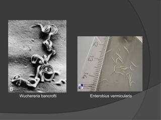 Wuchereria bancrofti​ Enterobius vermicularis
 