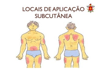 LOCAIS DE APLICAÇÃO
SUBCUTÂNEA
 