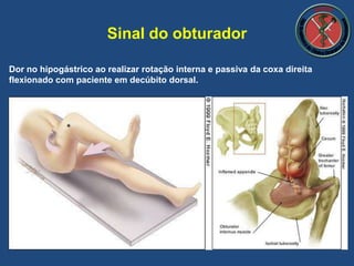 Sinal do obturador
Dor no hipogástrico ao realizar rotação interna e passiva da coxa direita
flexionado com paciente em decúbito dorsal.
 