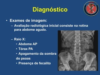• Exames de imagem:
– Avaliação radiológica inicial consiste na rotina
para abdome agudo.
– Raio X:
• Abdome AP
• Tórax PA
• Apagamento da sombra
do psoas
• Presença de fecalito
Diagnóstico
 