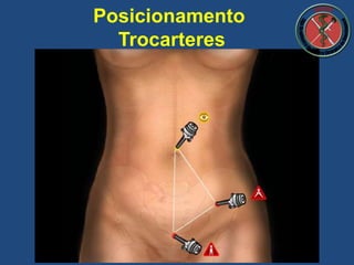 Posicionamento
Trocarteres
 