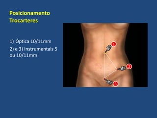 Posicionamento
Trocarteres
1) Óptica 10/11mm
2) e 3) Instrumentais 5
ou 10/11mm
1
3
2
 