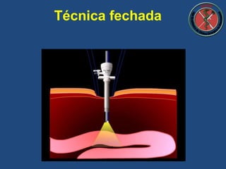 Técnica fechada
 