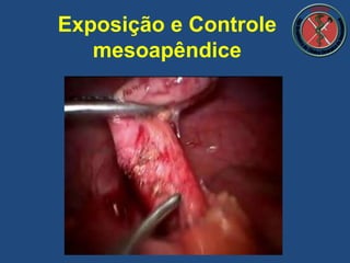 Exposição e Controle
mesoapêndice
 