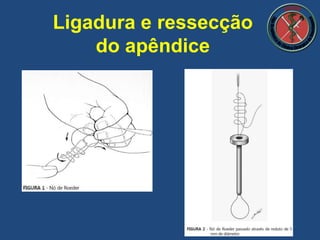 Ligadura e ressecção
do apêndice
 