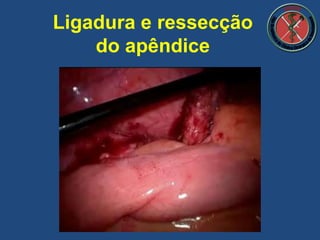 Ligadura e ressecção
do apêndice
 