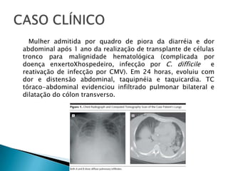 Mulher admitida por quadro de piora da diarréia e dor
abdominal após 1 ano da realização de transplante de células
tronco para malignidade hematológica (complicada por
doença enxertoXhospedeiro, infecção por C. difficile       e
reativação de infecção por CMV). Em 24 horas, evoluiu com
dor e distensão abdominal, taquipnéia e taquicardia. TC
tóraco-abdominal evidenciou infiltrado pulmonar bilateral e
dilatação do cólon transverso.
 