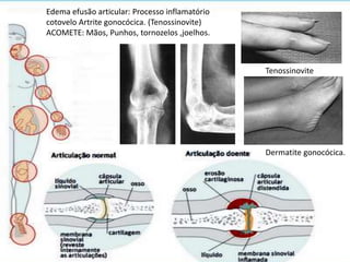 Dermatite gonocócica.
Edema efusão articular: Processo inflamatório
cotovelo Artrite gonocócica. (Tenossinovite)
ACOMETE: Mãos, Punhos, tornozelos ,joelhos.
Tenossinovite
 