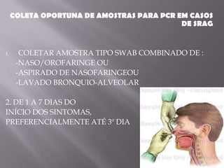 COLETA OPORTUNA DE AMOSTRAS PARA PCR EM CASOS
                                           DE SRAG


1.     COLETAR AMOSTRA TIPO SWAB COMBINADO DE :
      -NASO/OROFARINGE OU
      -ASPIRADO DE NASOFARINGEOU
      -LAVADO BRONQUIO-ALVEOLAR

2. DE 1 A 7 DIAS DO
INÍCIO DOS SINTOMAS,
PREFERENCIALMENTE ATÉ 3º DIA
 
