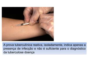 A prova tuberculínica reativa, isoladamente, indica apenas a
presença de infecção e não é suficiente para o diagnóstico
da tuberculose doença
 
