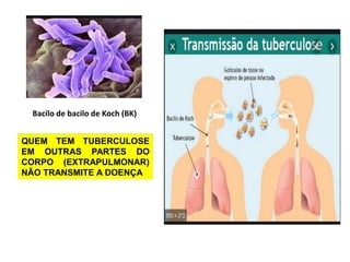 Bacilo de bacilo de Koch (BK)
QUEM TEM TUBERCULOSE
EM OUTRAS PARTES DO
CORPO (EXTRAPULMONAR)
NÃO TRANSMITE A DOENÇA
 