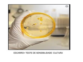 ESCARRO+ TESTE DE SENSIBILIDADE: CULTURA
 