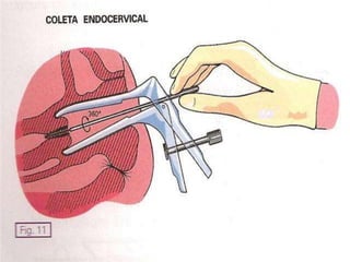 TIPOS DE COLOInflamadoNormal