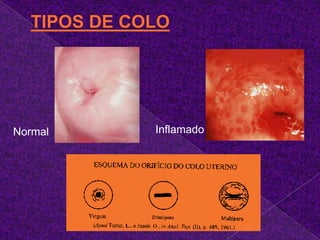 O exame citológico quando se apresenta com resultado indicativo de alguma alteração malígna ou pré-maligna sugere que esta mulher pode ter uma lesão no colo uterino.
