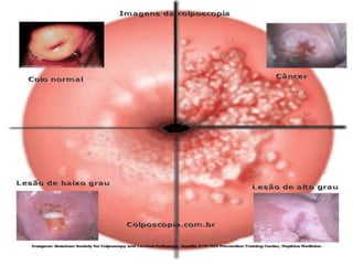 HPV  Aproximadamente 130 tipos;