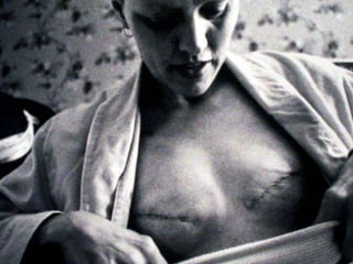 Exposição a radiação  em idade inferior a 35 anosSintomas:Aparecimento de nódulo indolor na mama ou região axilar.Podendo causar coceira e irritação.