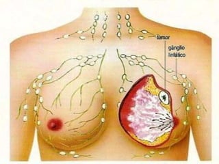 Diante do espelho, com o braço atrás da cabeça, toque, com as pontas dos dedos, o seio, as axilas e os mamilos. Verifique a ocorrência de dor em algum local, de nódulos, de caroços ou de líquidos que saiam dos mamilos. Se houver qualquer alteração, o médico deve ser procurado.