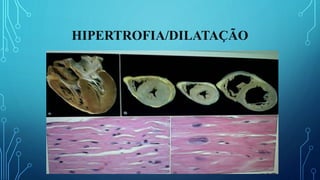 HIPERTROFIA/DILATAÇÃO
 